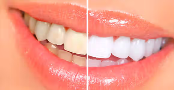 Después del blanqueamiento dental
