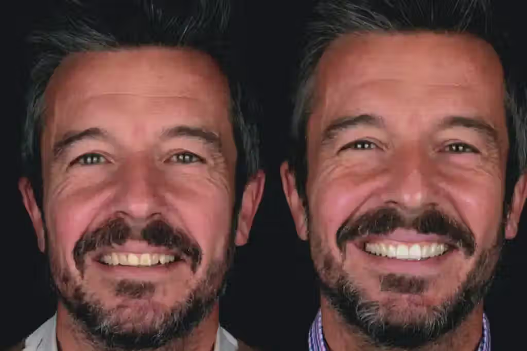 Resultado de carillas dentales