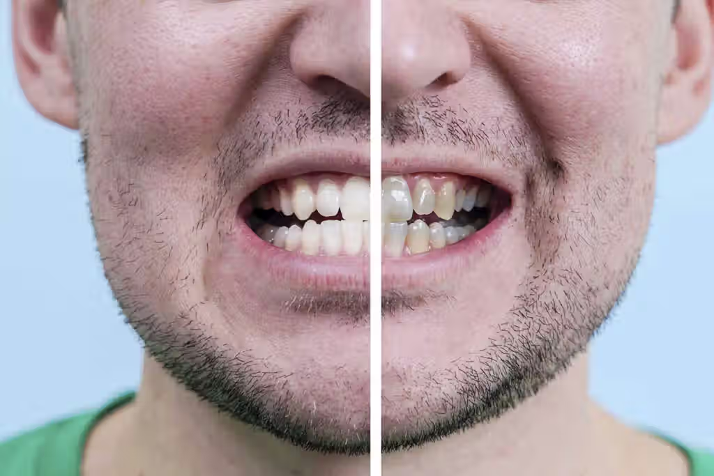 Resultado de carillas dentales