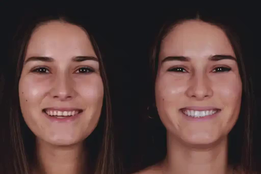 Resultado de carillas dentales